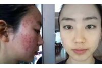 【武漢研多萃】怎么快速去除痘痘和痘印呢？想去除臉上痘印